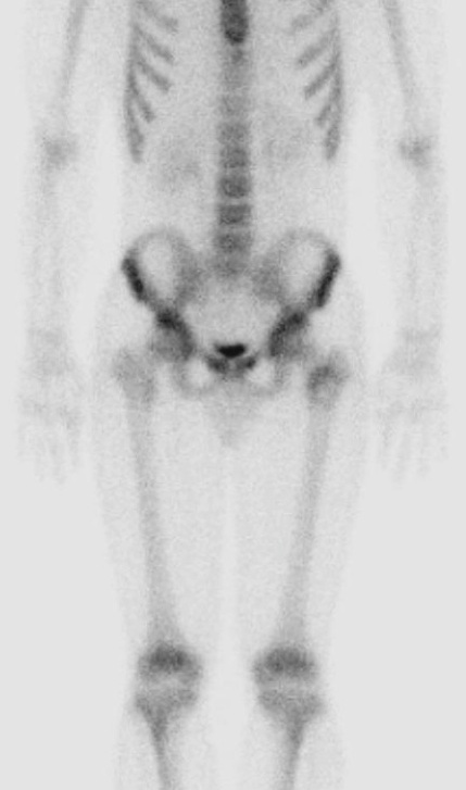 Figure 3 for case fibrous dysplasia ( RID3738 )